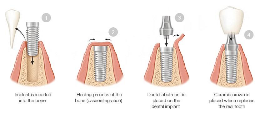 Dental Implant Process near North Vernon, IN